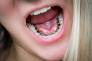 Lingual Braces: The Invisible Orthodontic Solution