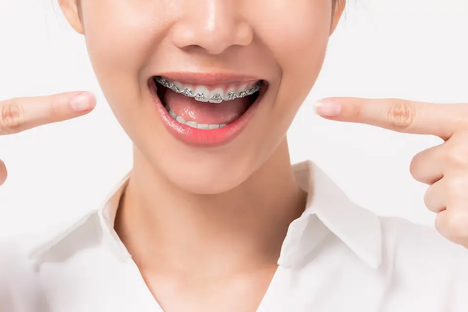 How Lingual Braces Work? Everything You need to know