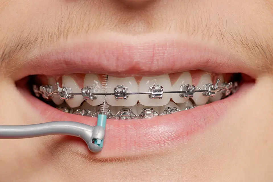 Cómo usar hilo dental con brackets
