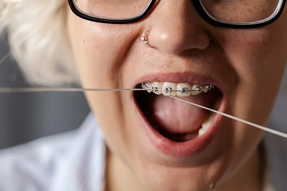 How to Floss with Braces: Special Techniques for a Superior Smile