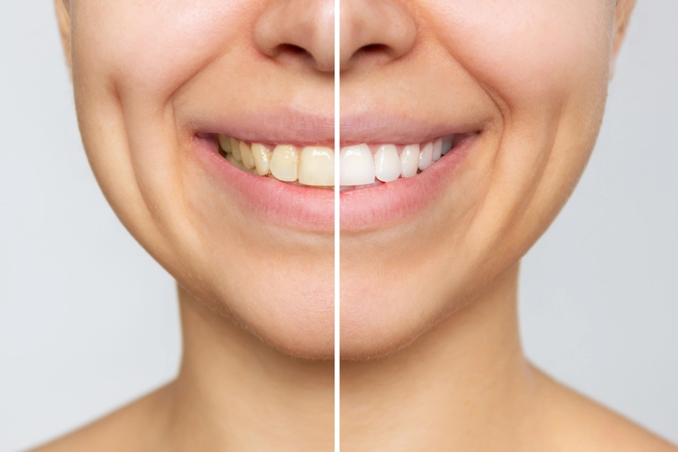 Natural Teeth Whitening: A Comprehensive Guide