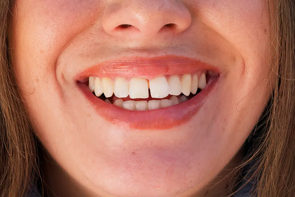 Teeth Whitening at Home