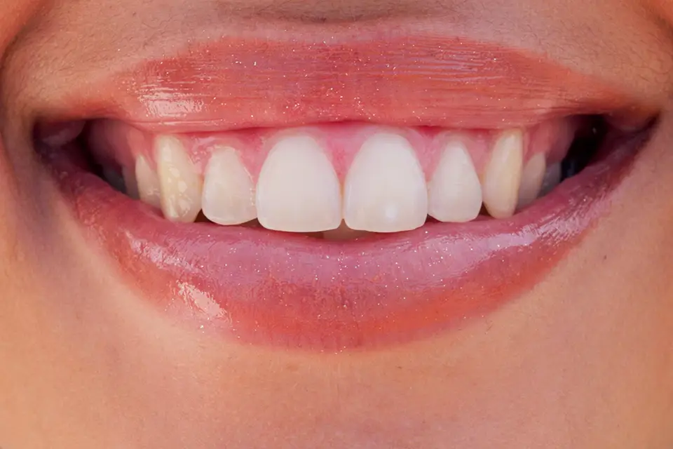Blanqueamiento Dental con Peróxido de Hidrógeno