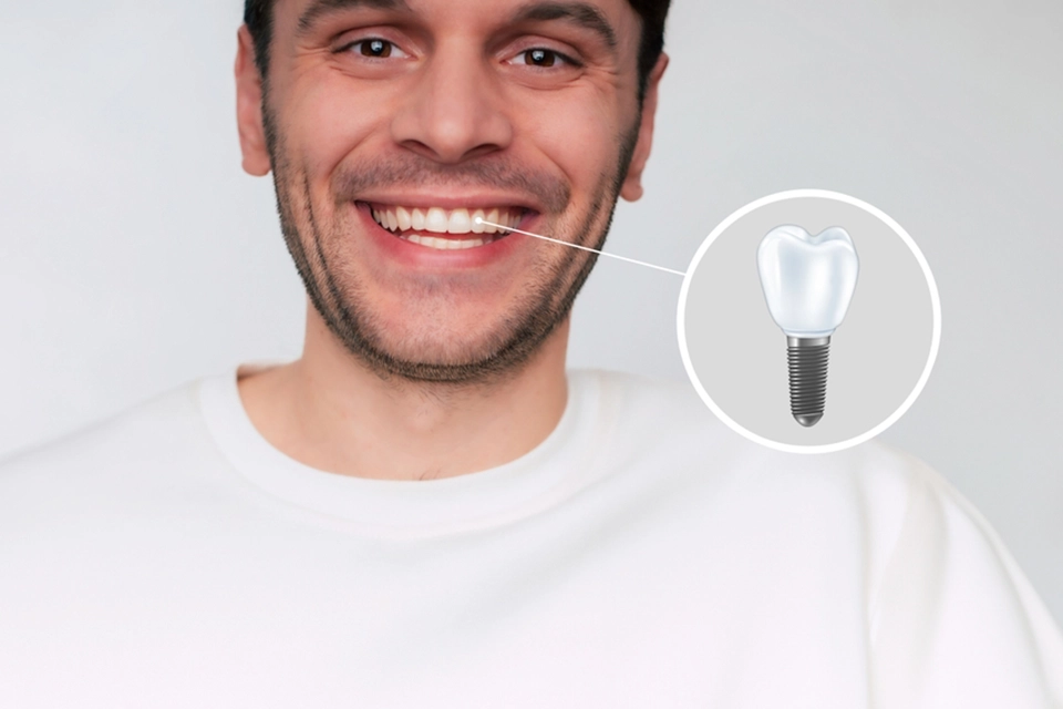 Dental Implants Procedure: Everything You Need to Know