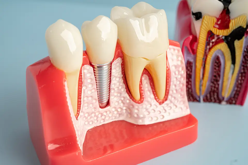 Dental Implants Side Effects