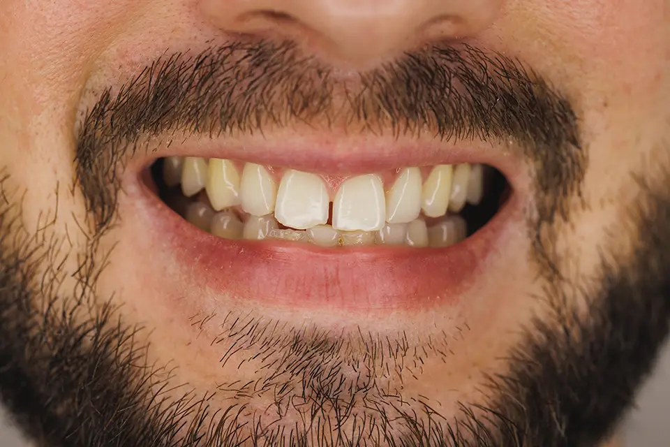 Dental Crown Front Tooth