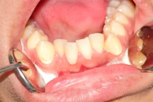 What Are Bicuspid Teeth?