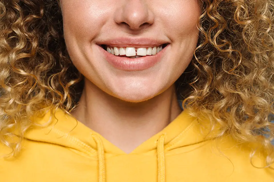 Corona Dental para Diente Frontal
