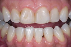 What Are Anterior Teeth?