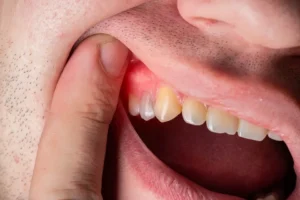 Infection After Tooth Extraction: What You Need to Know