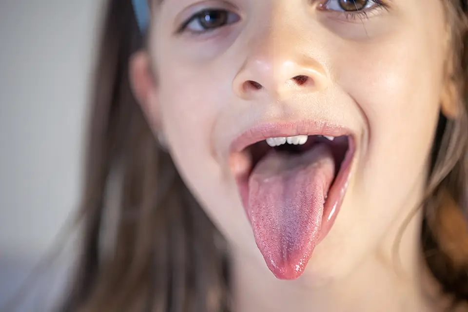 Bultos en la Parte Posterior de la Lengua