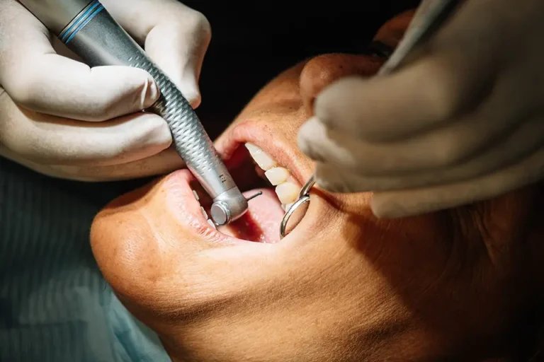 Deep Cleaning Teeth Cost: What to Expect in Houston
