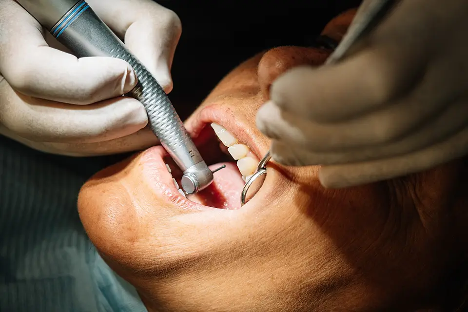 Deep Cleaning Teeth Cost: What to Expect in Houston