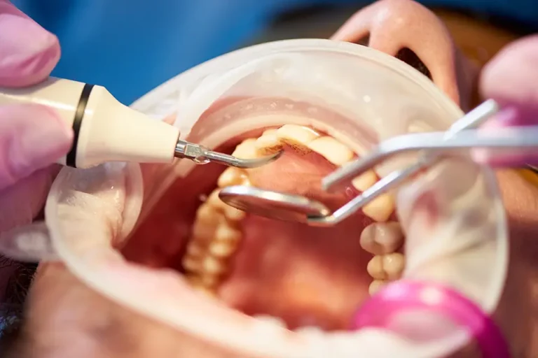 What to Do About a Wisdom Tooth Cavity in Houston