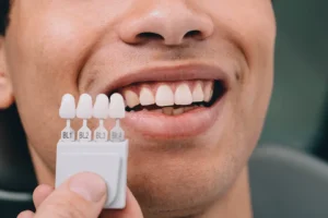 Discover the Best Dental Veneers at Zara Dental in Houston, Texas