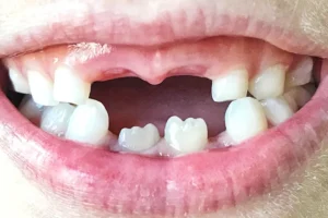 Missing Front Tooth in Houston: What Are Your Options?