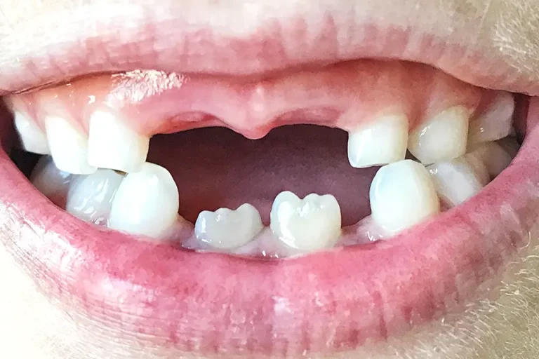 Missing Front Tooth in Houston: What Are Your Options?