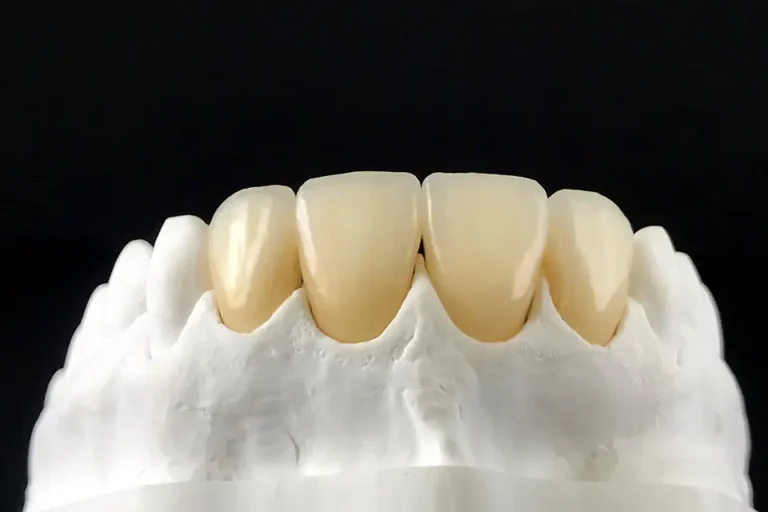 What Are CEREC Same-Day Crowns and How Do They Work?