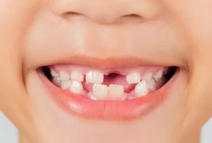 Periodontal Disease in Children