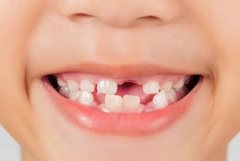 Periodontal Disease in Children