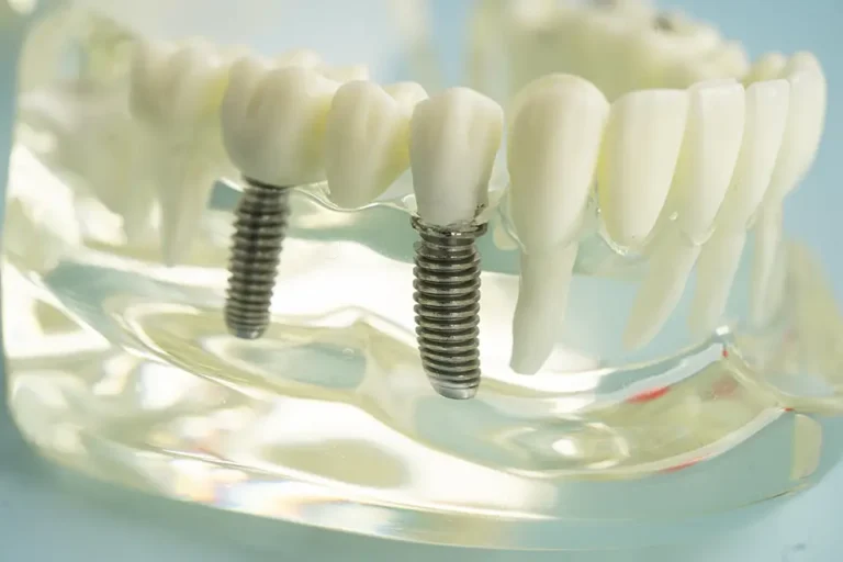 Same Day Dental Implants: A Complete Guide