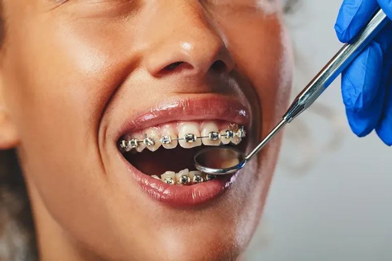 Types of Braces: A Practical Guide for Houston Patients