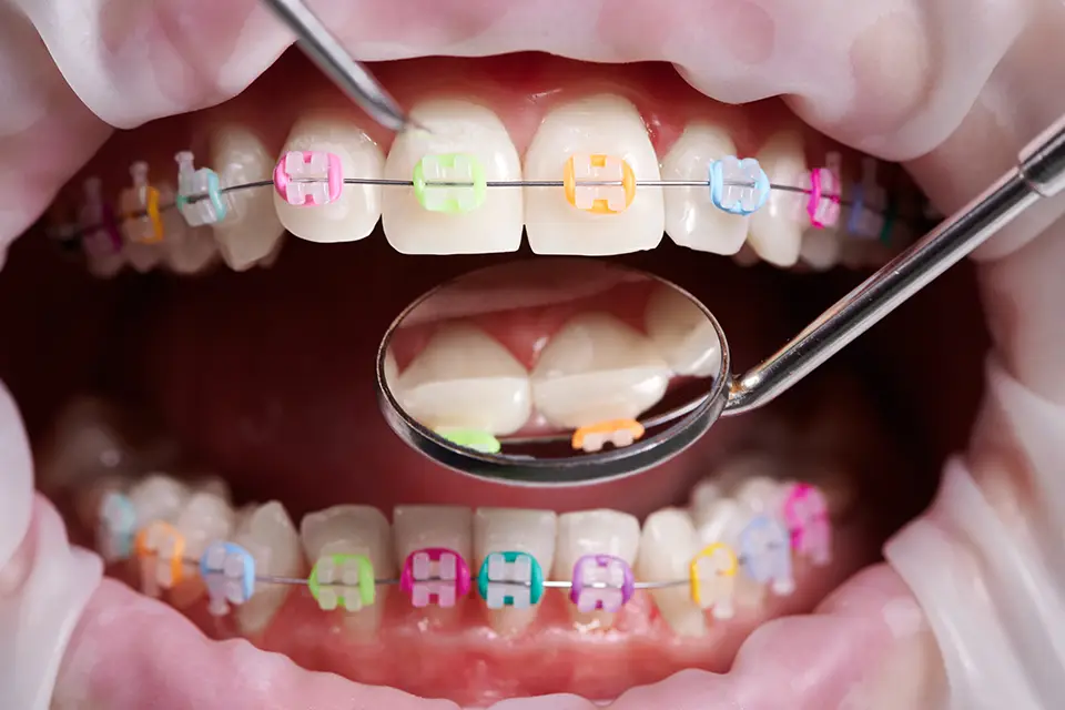 Tooth-Colored Braces: Subtle, Effective Alignment with Zara Dental