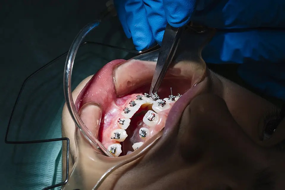 teenage-at-the-dental-clinic-putting-bracket - Zara Dental Clinic - Houston Self-Ligating Braces: A Modern, Efficient Path to a Straighter Smile