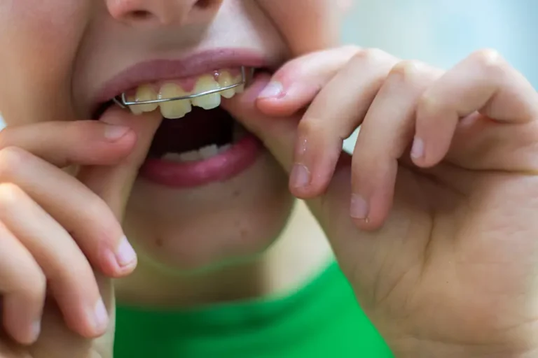 Braces Alternatives for Kids: Clear Aligners, Expanders, and Options in Houston