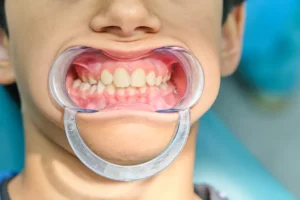 Palatal Expanders for Kids in Houston: Best Age, Pain Level, and What to Expect