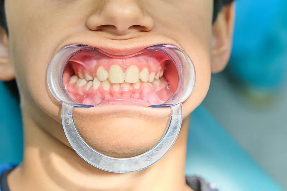 Palatal Expanders for Kids in Houston: Best Age, Pain Level, and What to Expect