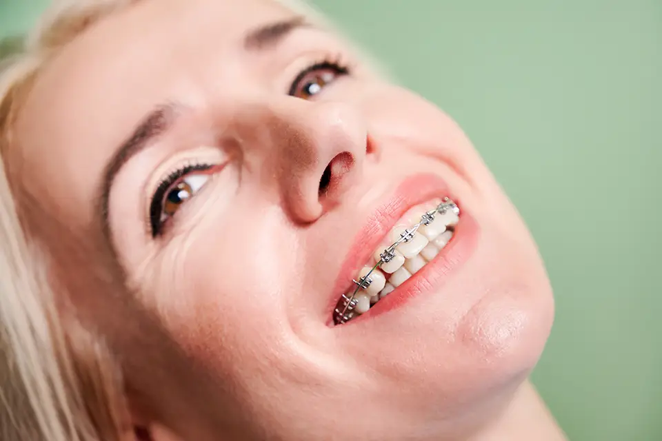 Which Is Better, Metal or Ceramic Braces? Choose Based on Goals, Budget, and Lifestyle