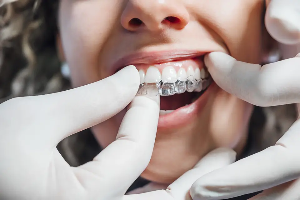 Metal Braces vs Invisalign: Key Differences in Appearance, Comfort, and Lifestyle