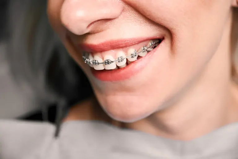 Metal vs. Ceramic Braces: Differences, Pros and Cons, Cost, and Which Is Best for You