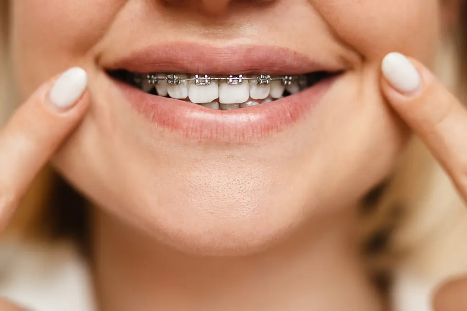 Metal vs. Lingual Braces: Differences in Visibility, Comfort, Cost, and Results