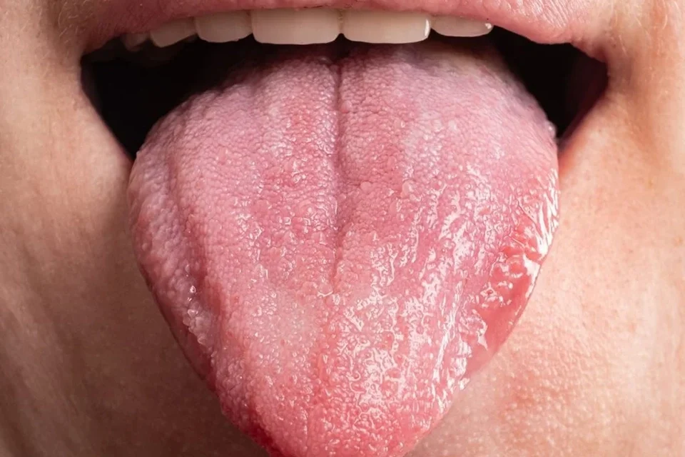 Common Causes of Bumps on the Back of the Tongue