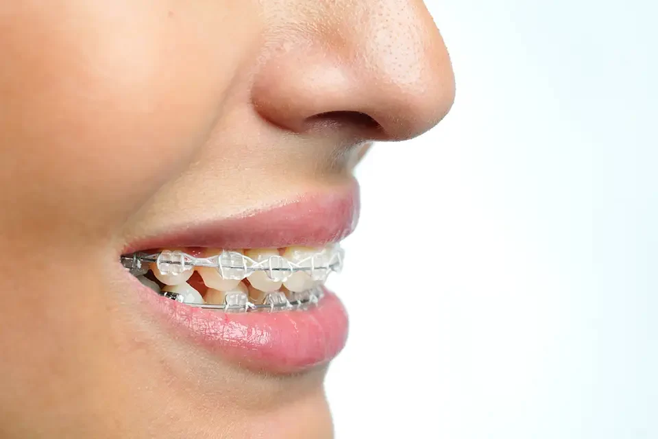 What are Clear Braces for Adults?