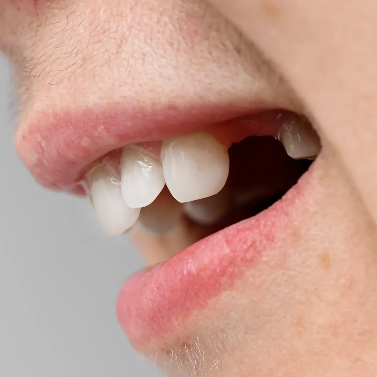 Close-up of woman's teeth after dental extractions