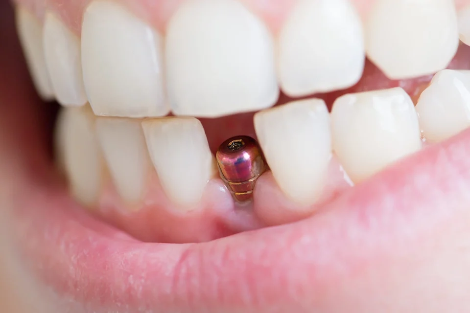 Dental Implant Procedure Step-by-Step