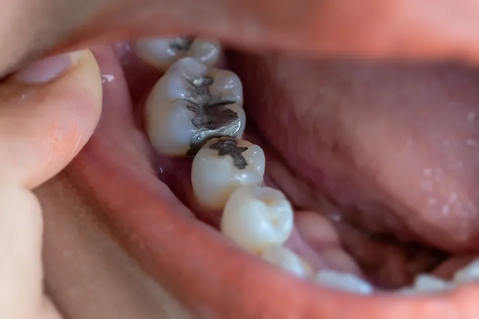 Replacing Old Dental Fillings: Tooth-Colored vs. Silver Fillings