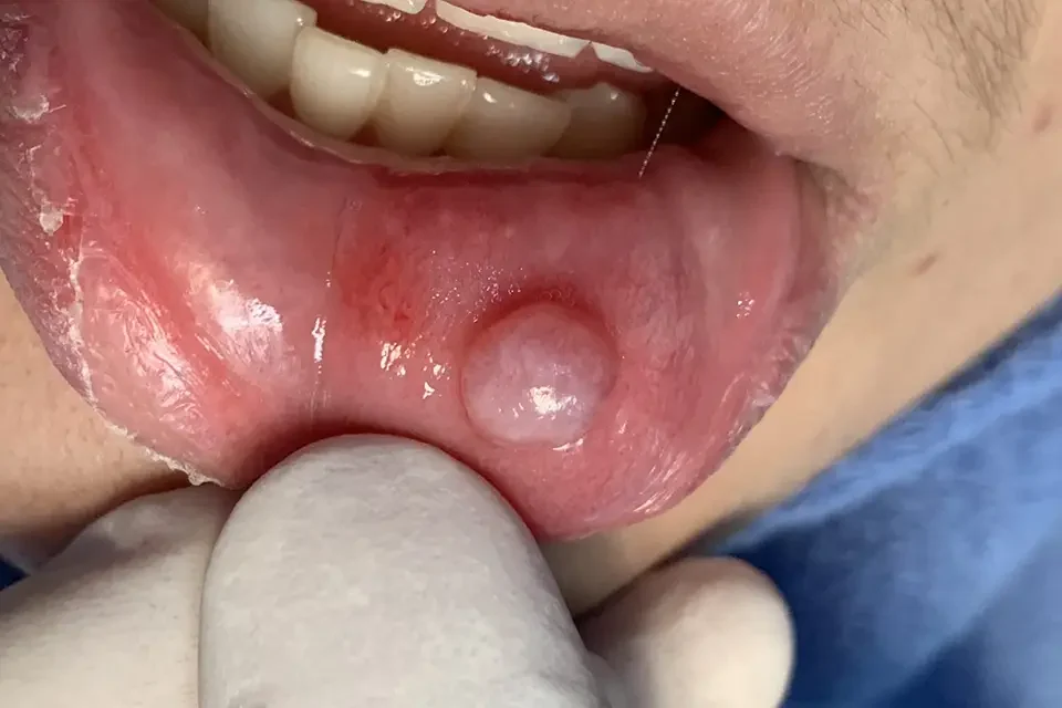 Oral Cyst Removal in Houston: What to Expect