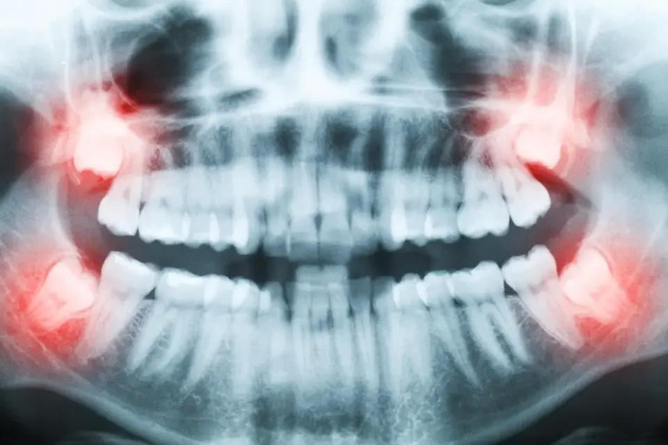 When to Consider Wisdom Teeth Removal