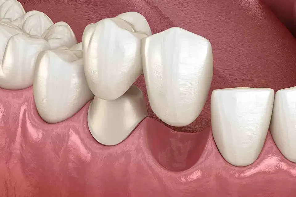 Alternatives to Cantilever Dental Bridges