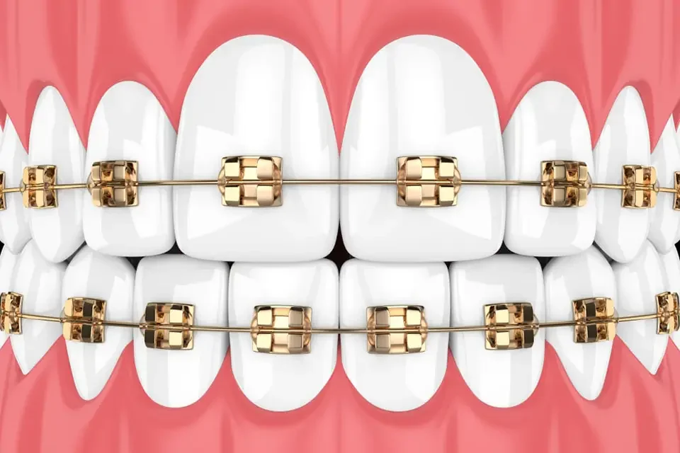 What Are Gold Braces?