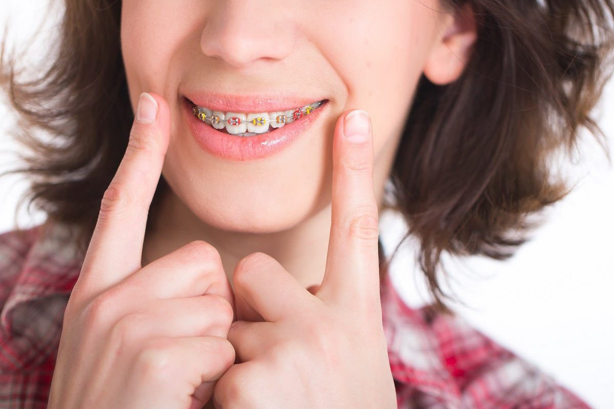 Affordable Braces in Houston, Texas