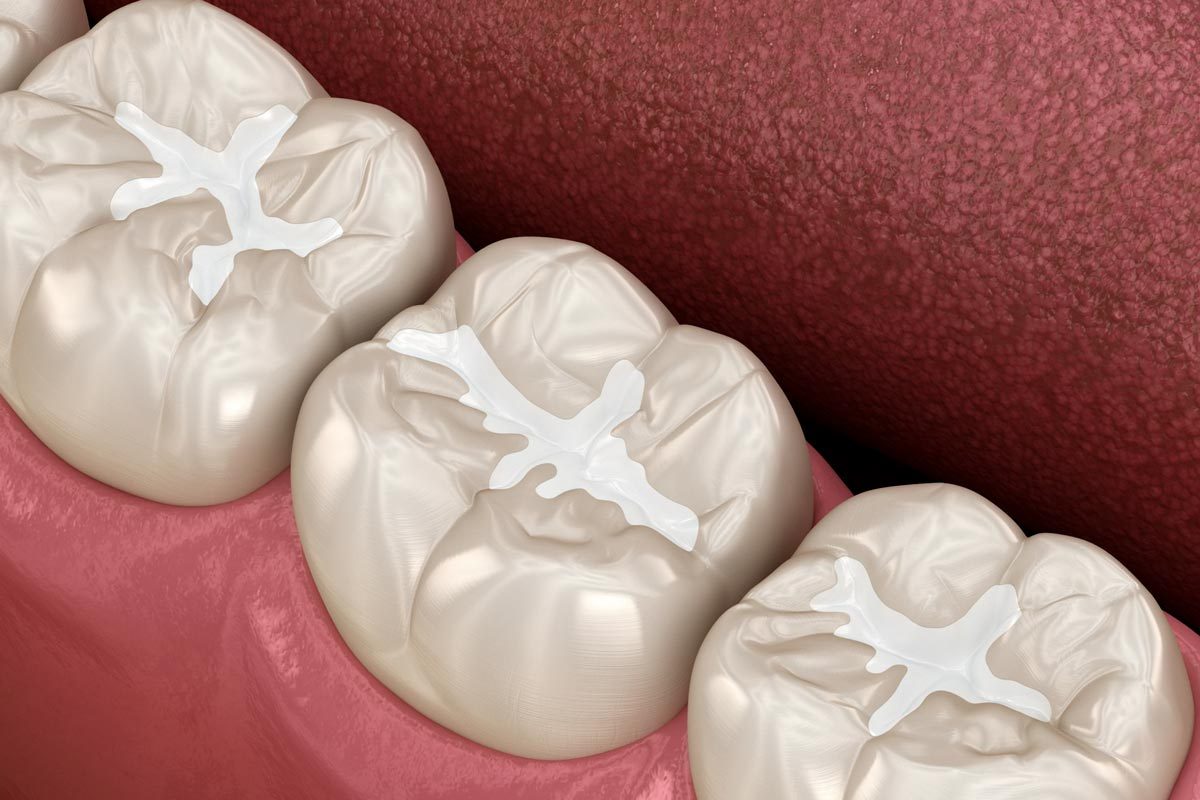 Common Questions About Dental Sealants
