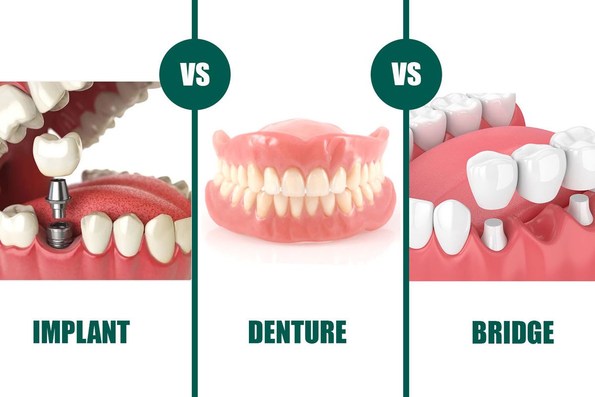 Implants vs Dentures vs Bridges