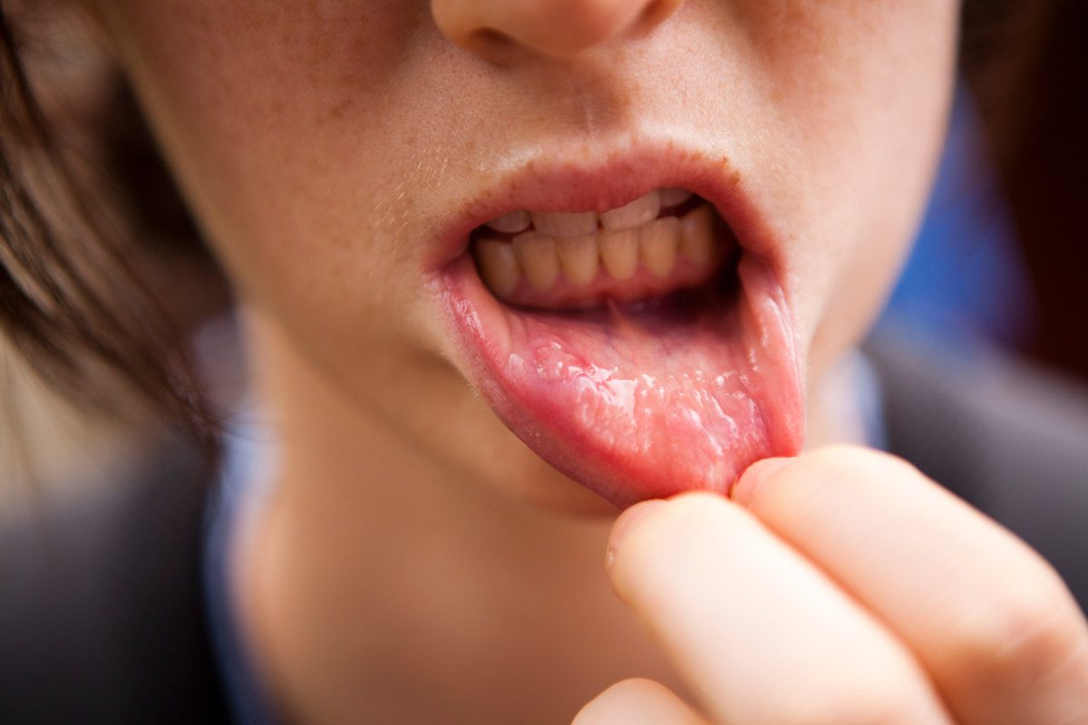 Mouth Ulcer Treatment