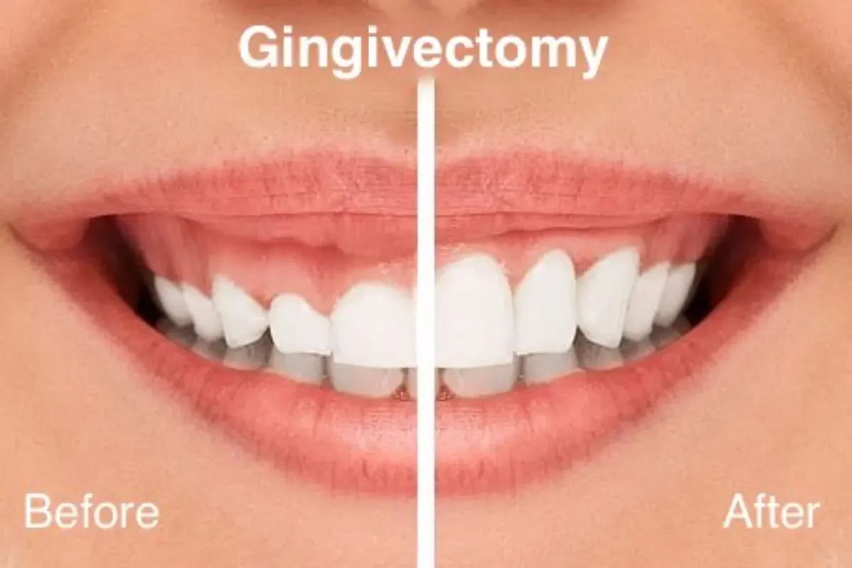 Surgical Treatment Options for Gummy Smiles