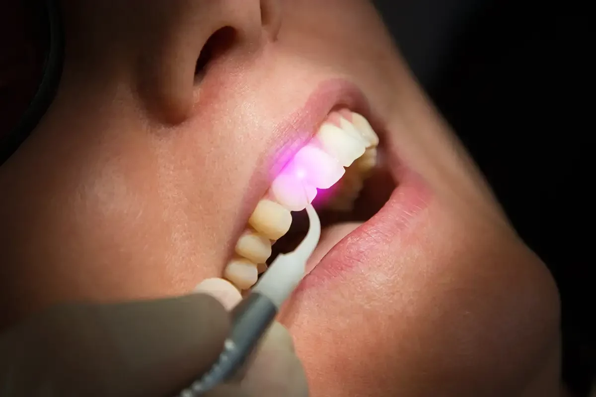Advantages of Utilizing Laser Therapy in Periodontal Treatment
